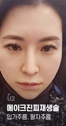 팔자주름 Real Before After! #shorts